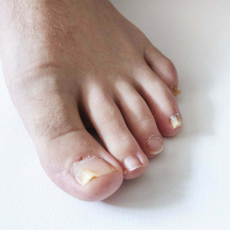 Closeup Of Male Toes With A Cracked Nail Stock Photo - Download Image Now -  Fingernail, Mountain Ridge, Toenail - iStock