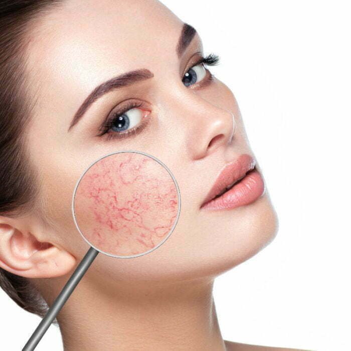 Redness, Thread Veins • MeadowView Aesthetics Skin Clinic and Laser