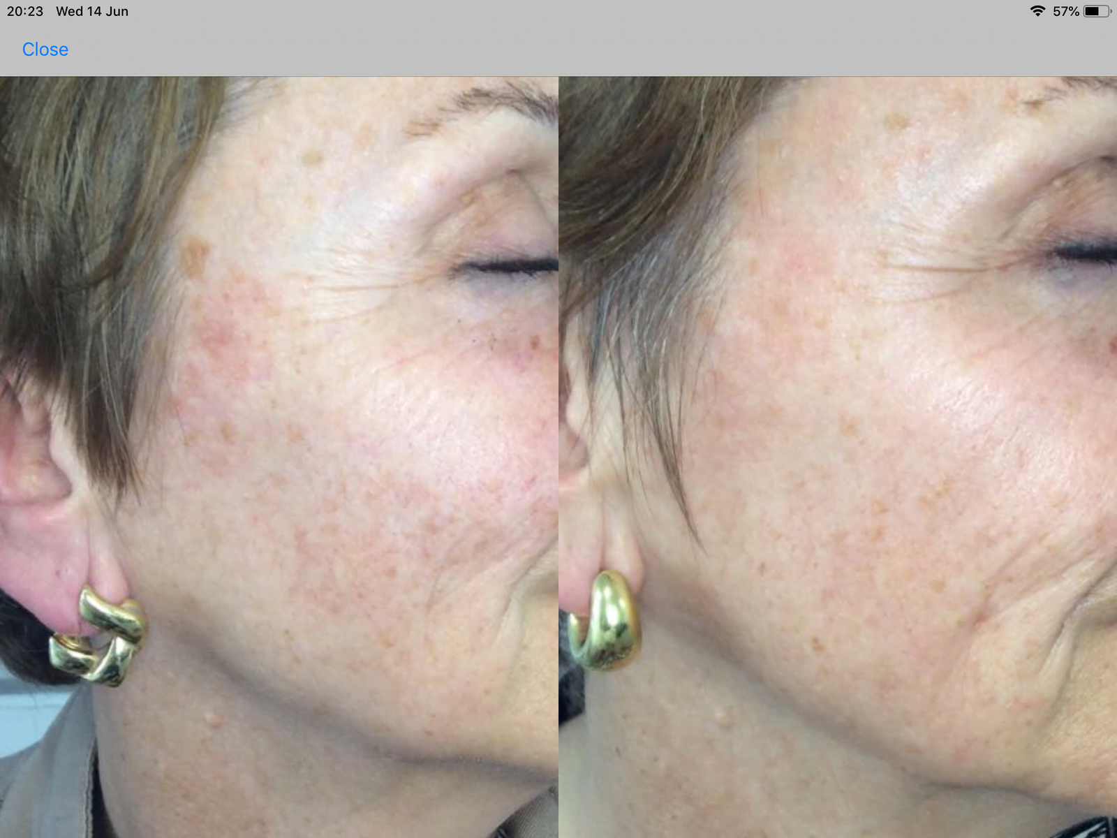 Skin Resurfacing Near Me Options for Optimal Results
