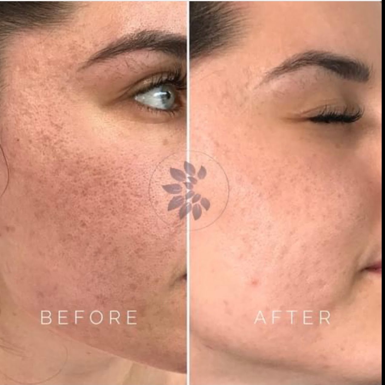 Skin resurfacing near me